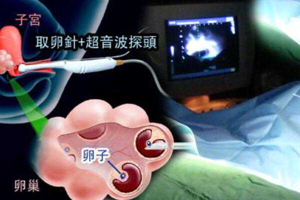 上海供卵生子流程及费用,上海试管婴儿成功率最高的医院榜单,上海九院试管婴